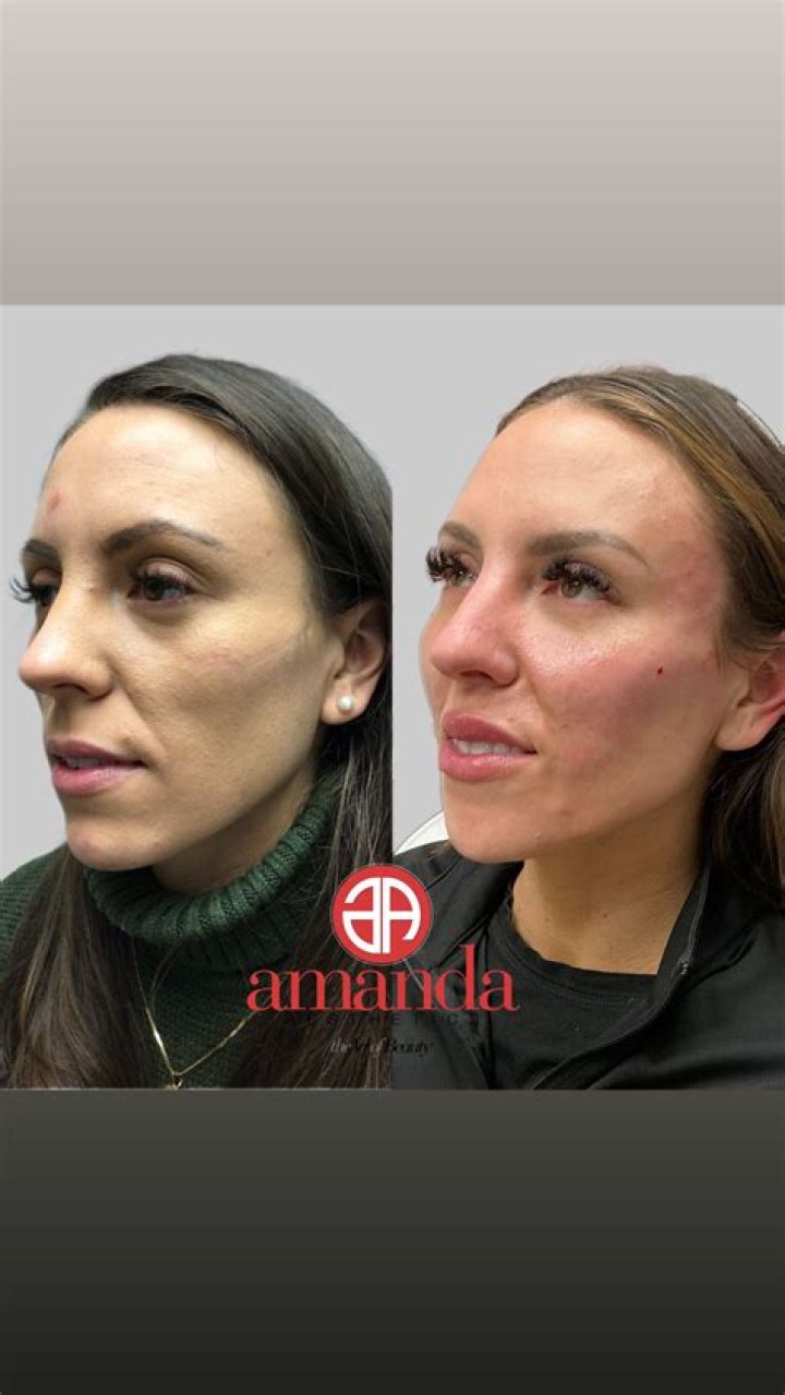 Amanda Stanton Gets Lip Injections on Instagram and Fans Kind of Hate It