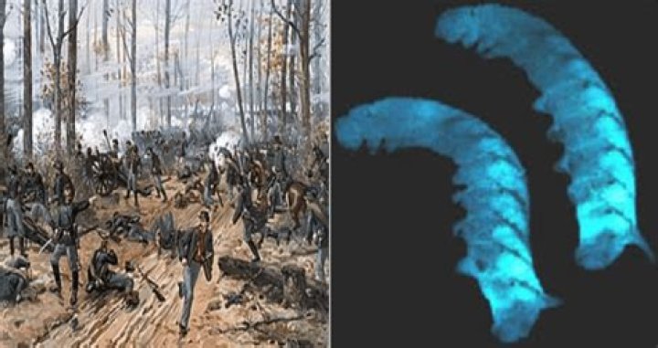 "Angel's Glow" And The Mystery Of The Civil War's Glow-In-The-Dark Wounds