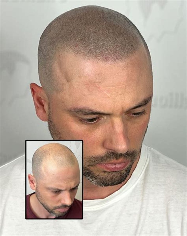 
Anthony Rizzo Bald- Losing Hair? Tattoo, Age, And Height 