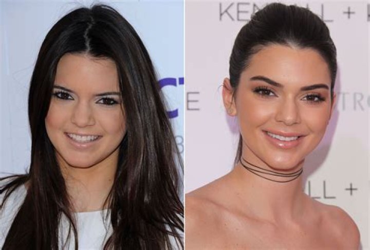 Kendall Jenner Before and After: See the Pics That Have Fans Speculating Plastic Surgery