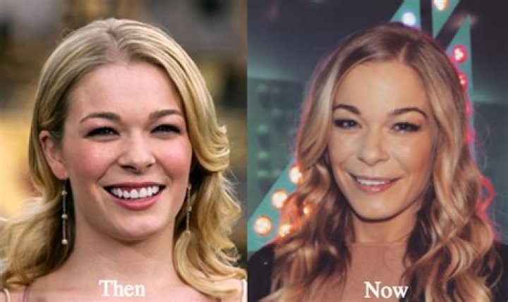LeAnn Rimes’ Slight Plastic Surgery Tweaks Include Botox and Laser Resurfacing, Experts Say (EXCLUSIVE)