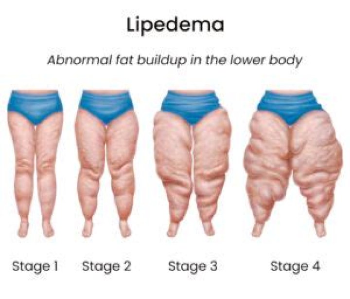 Чем вызвана липедема? – Celebrity.fm